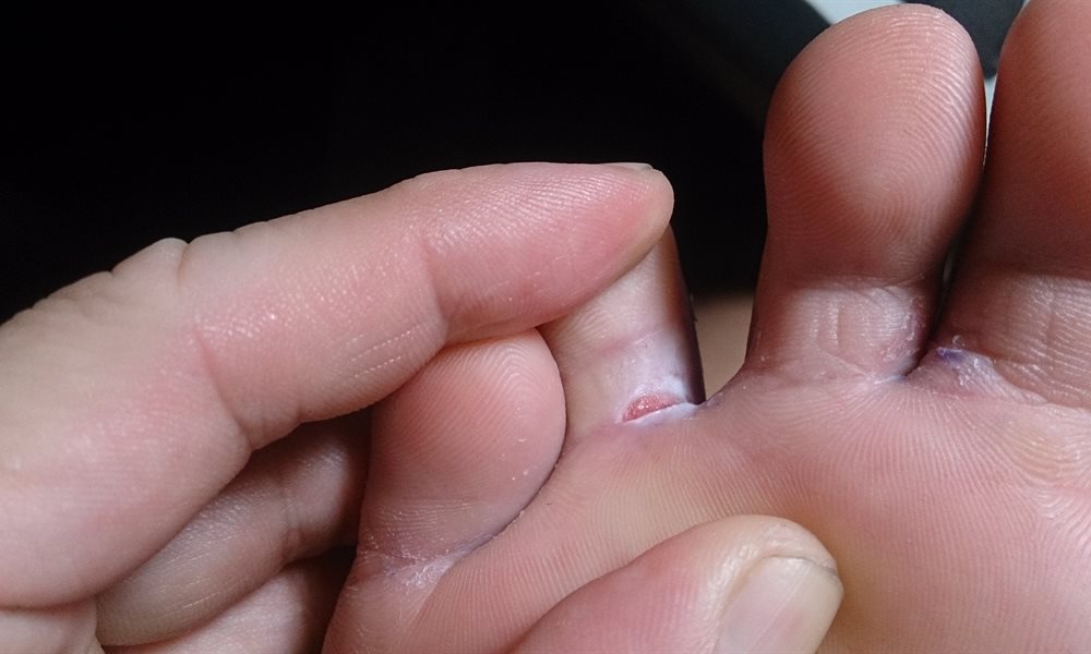 Blister Image Bikat