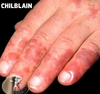 Mountain Illnesses