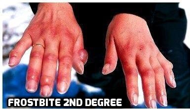 Mountain Illnesses